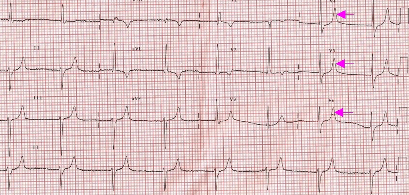 RBBB with LAHB & Junctional rhythm