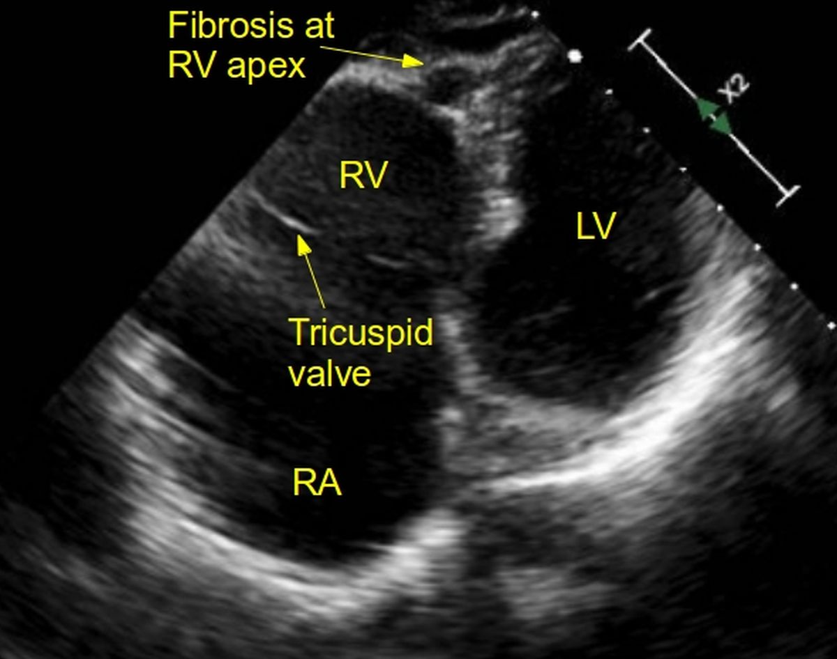 Echo image of right ventricular apex (RVA) pacemaker, pressure