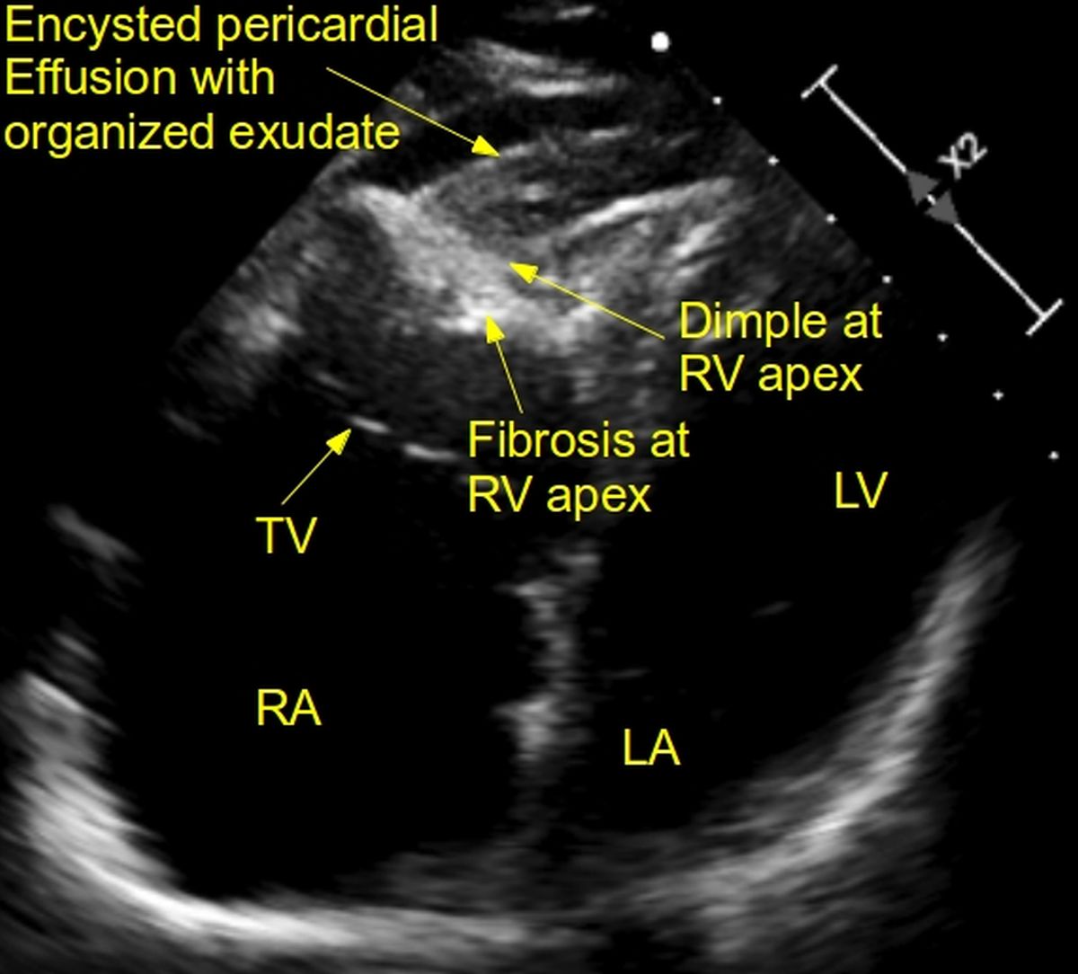 Multiple echo views in EMF - RV apical dimple & fibrosis