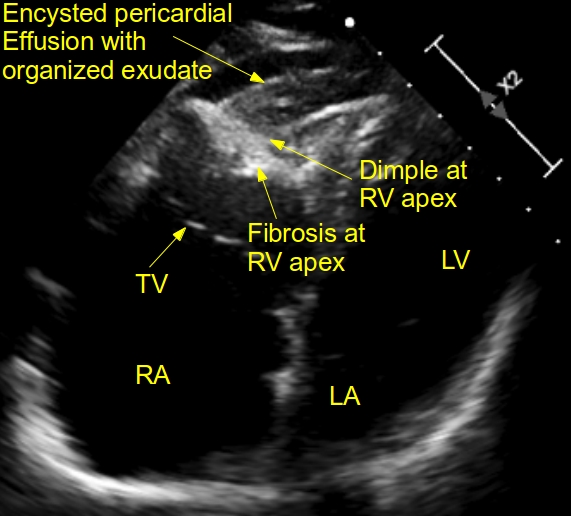 Echocardiogram showing typical features of EMF