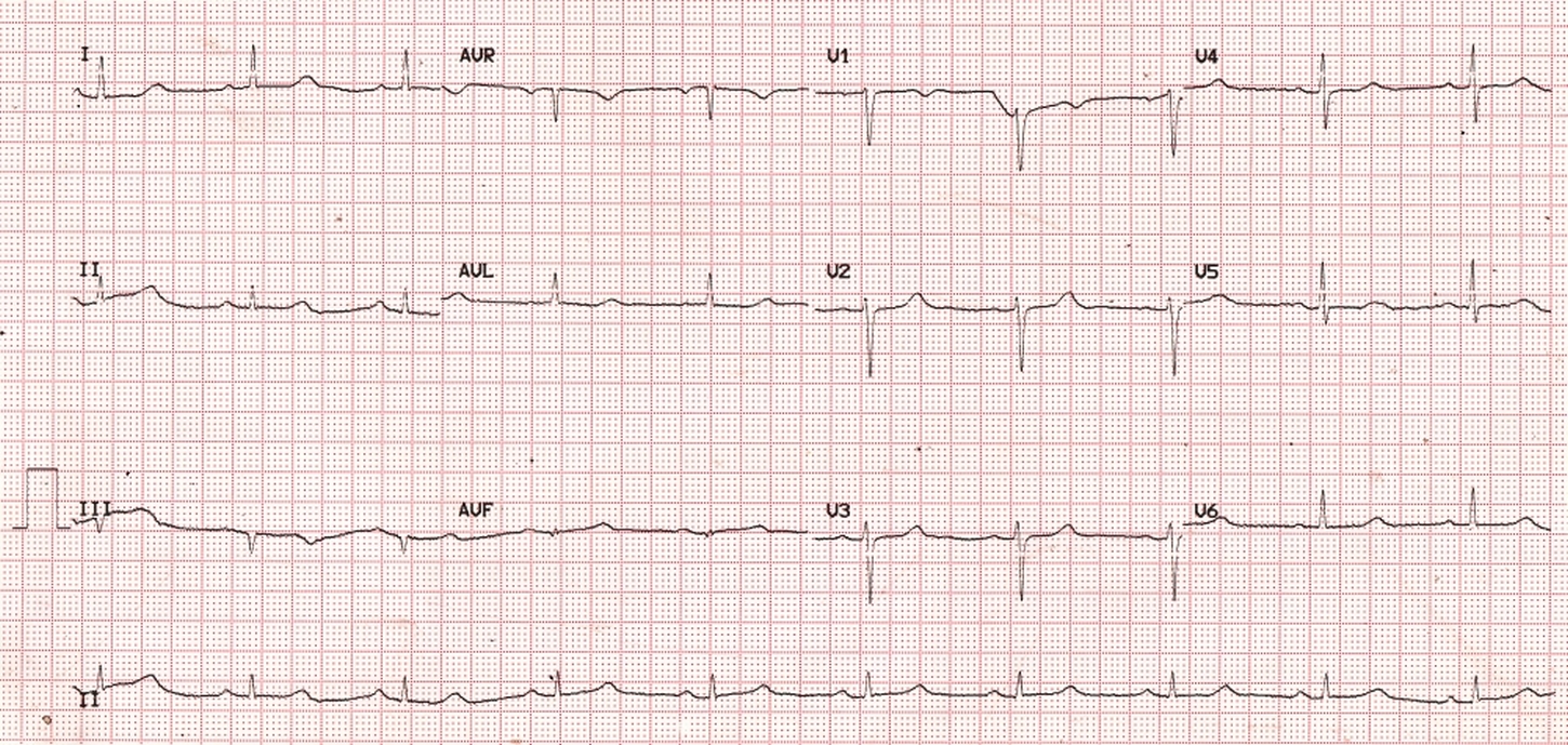 ST prolongation in hypocalcemia