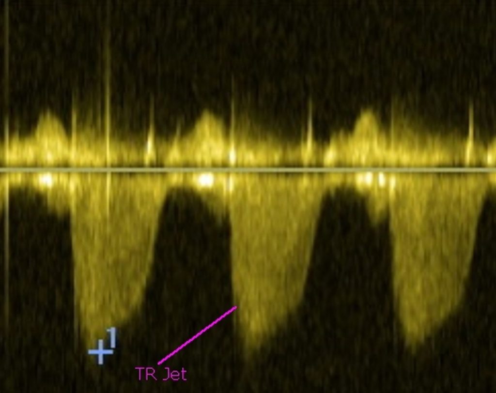 Tr Jet Rvsp Tricuspid Regurgitation Jet – Tricuspid valve regurgitation: current ...