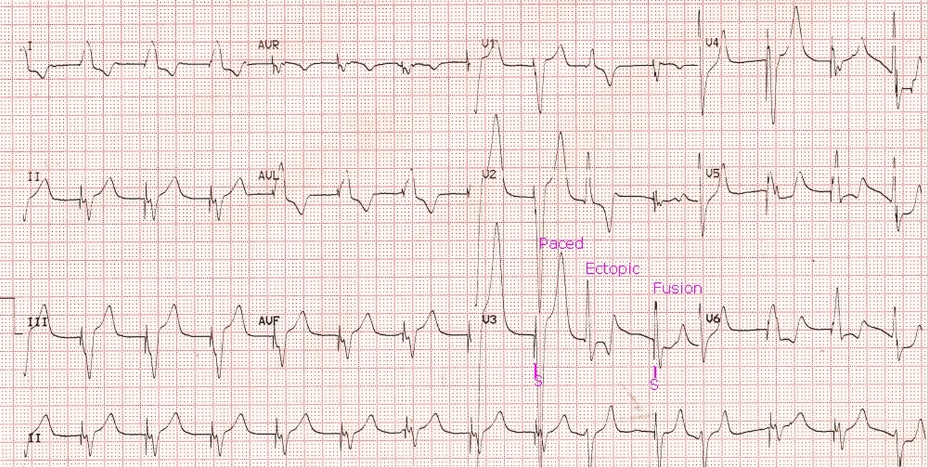 VVI pacing with ectopic beat and fusion beat