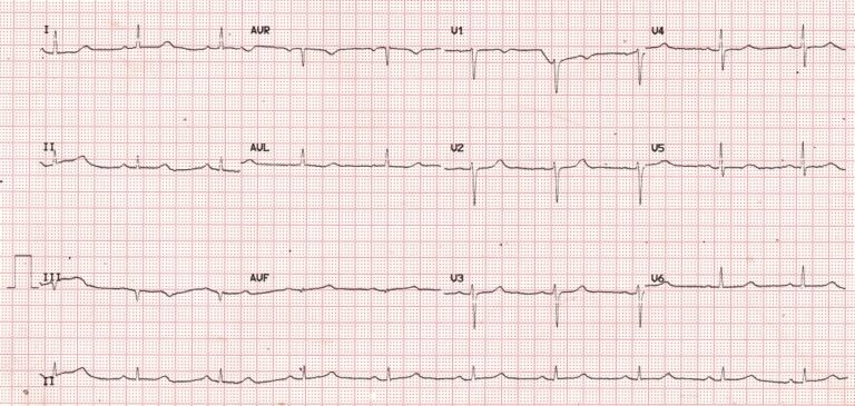 ecg – All About Cardiovascular System and Disorders