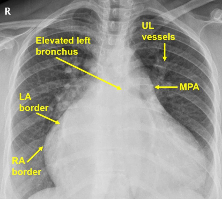 Biatrial enlargement on CXR – All About Cardiovascular System and Disorders