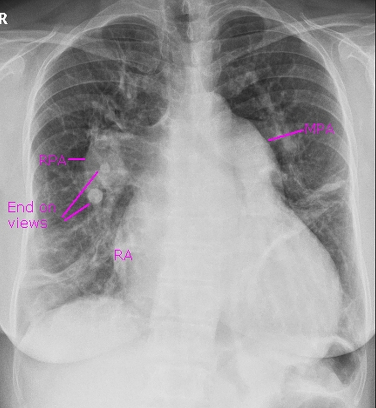 Severe pulmonary hypertension on CXR
