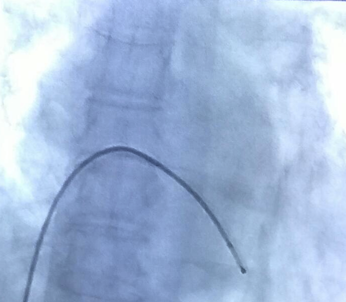 Temporary pacing electrode at right ventricular apex