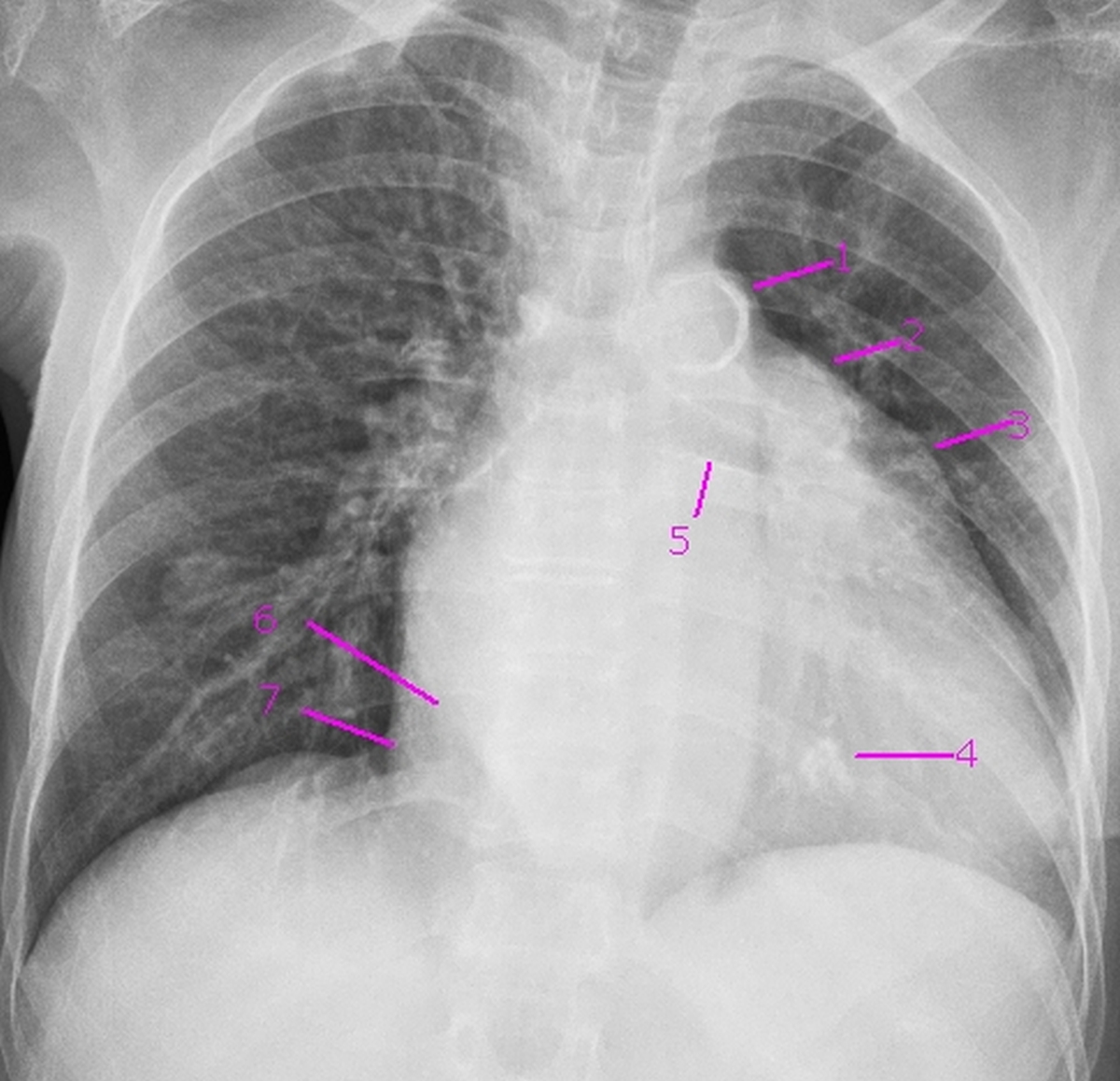 Calcification Des Valves Cardiaques Causes YNAVHY