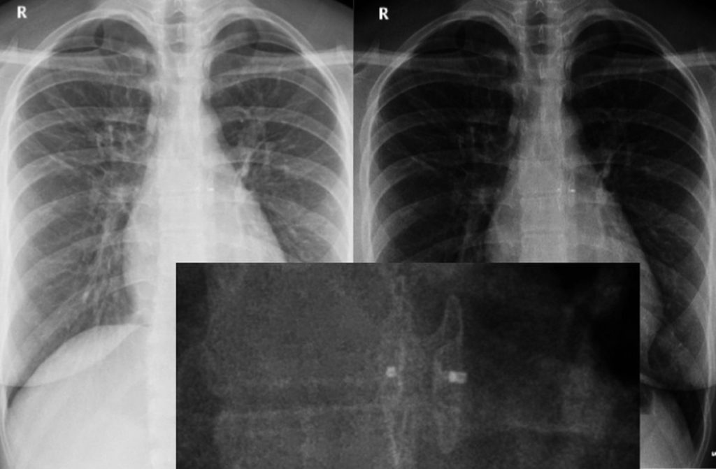 Device closing AP window is seen on chest X-ray PA view in different styles