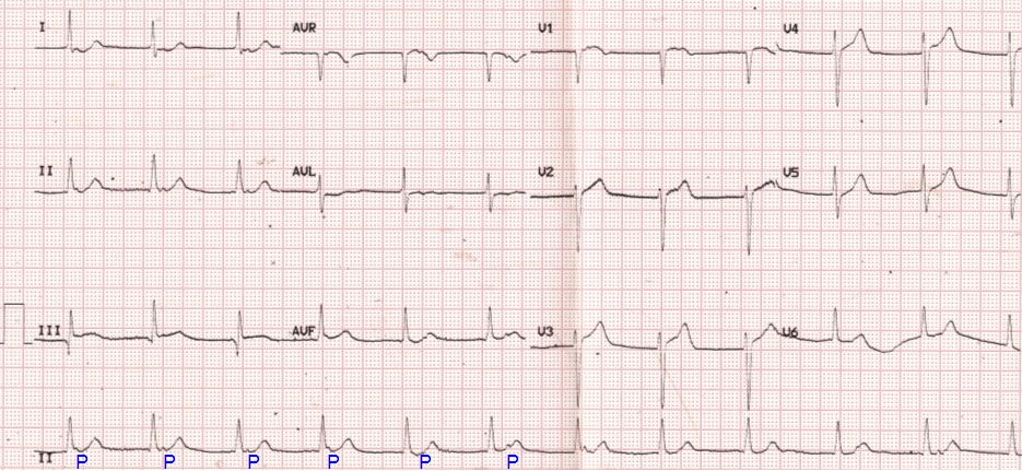 Isorhythmic AV dissociation