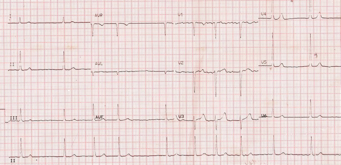 Atrial Fibrillation and Ventricular Dysfunction