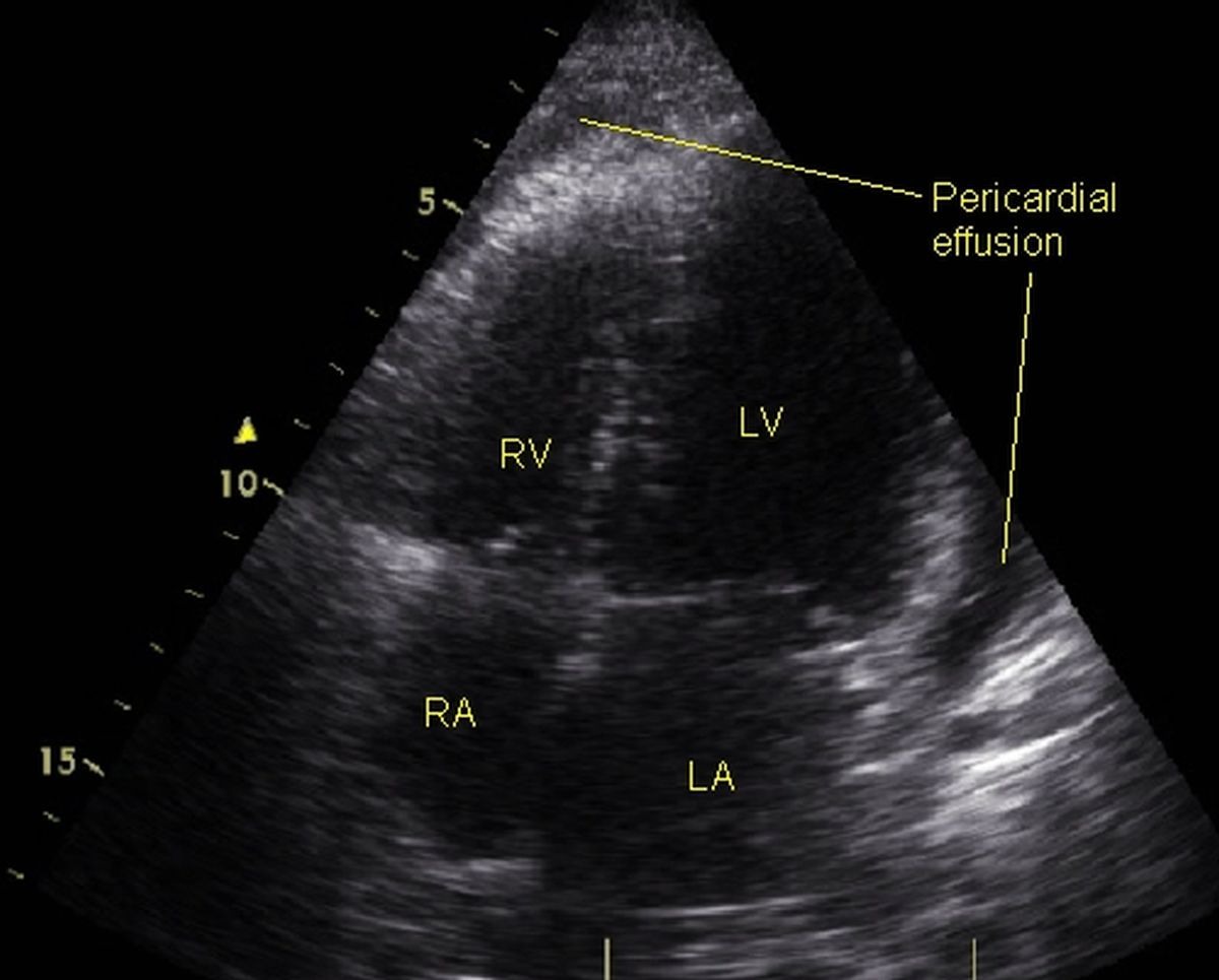 Mild pericardial effusion on echocardiography
