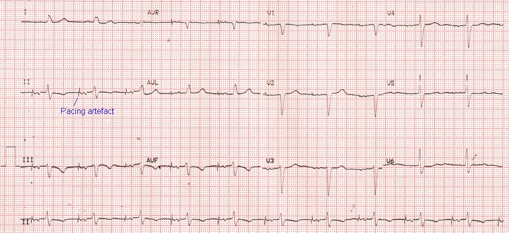 Atrial Pacing All About Cardiovascular System And Dis - vrogue.co