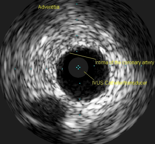 Coronary Intravascular Ultrasound