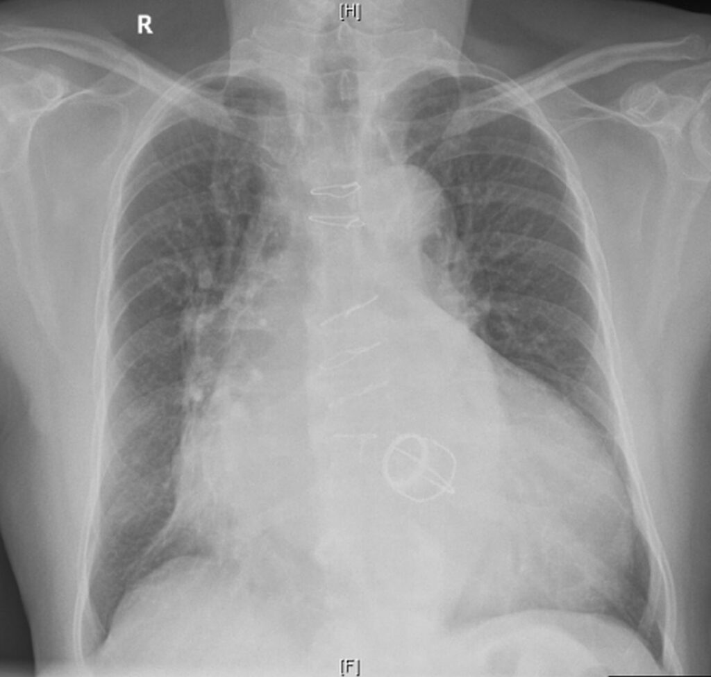 Tilting Disc Mitral Prosthetic Valve On X-ray Chest Pa View – All About 