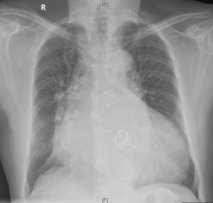 Starr–Edwards mitral prosthetic valve on CXR – All About Cardiovascular ...