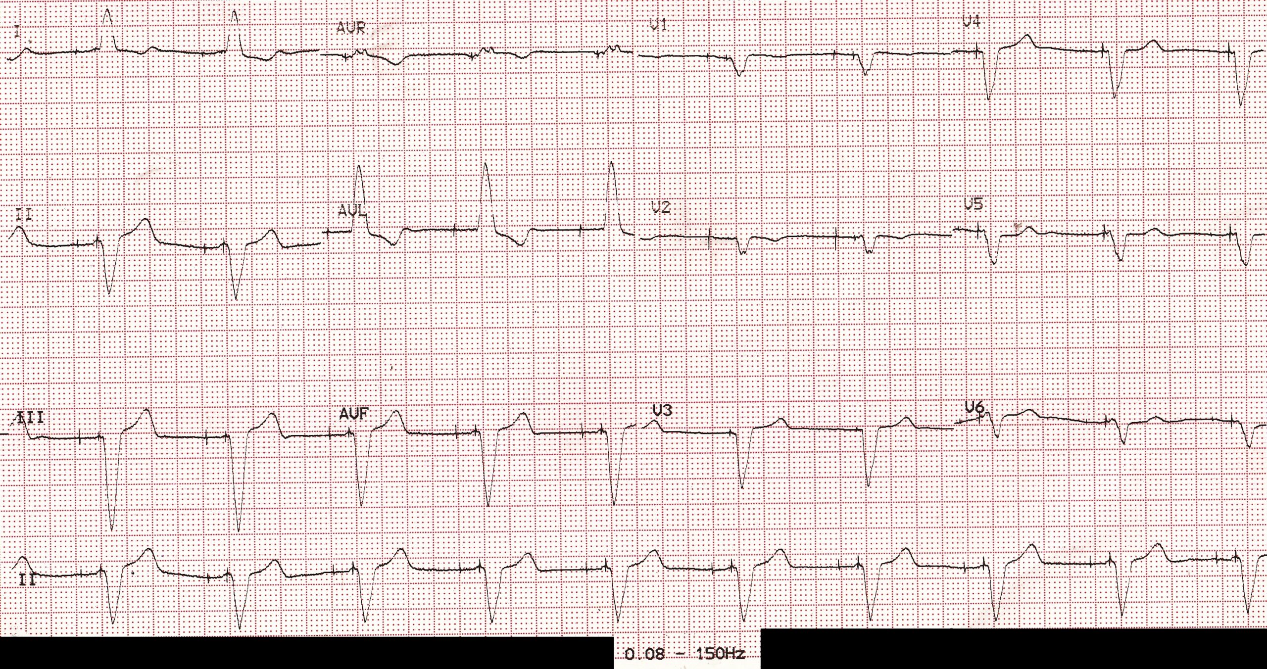 Filter setting and pacing spikes 2 – All About Cardiovascular System ...