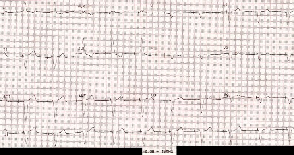 ECG filter settings and detection of pacemaker spikes – All About ...