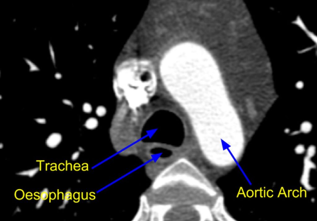 Cardiac Computed Tomographic Ct Scan Aortic Arch Level