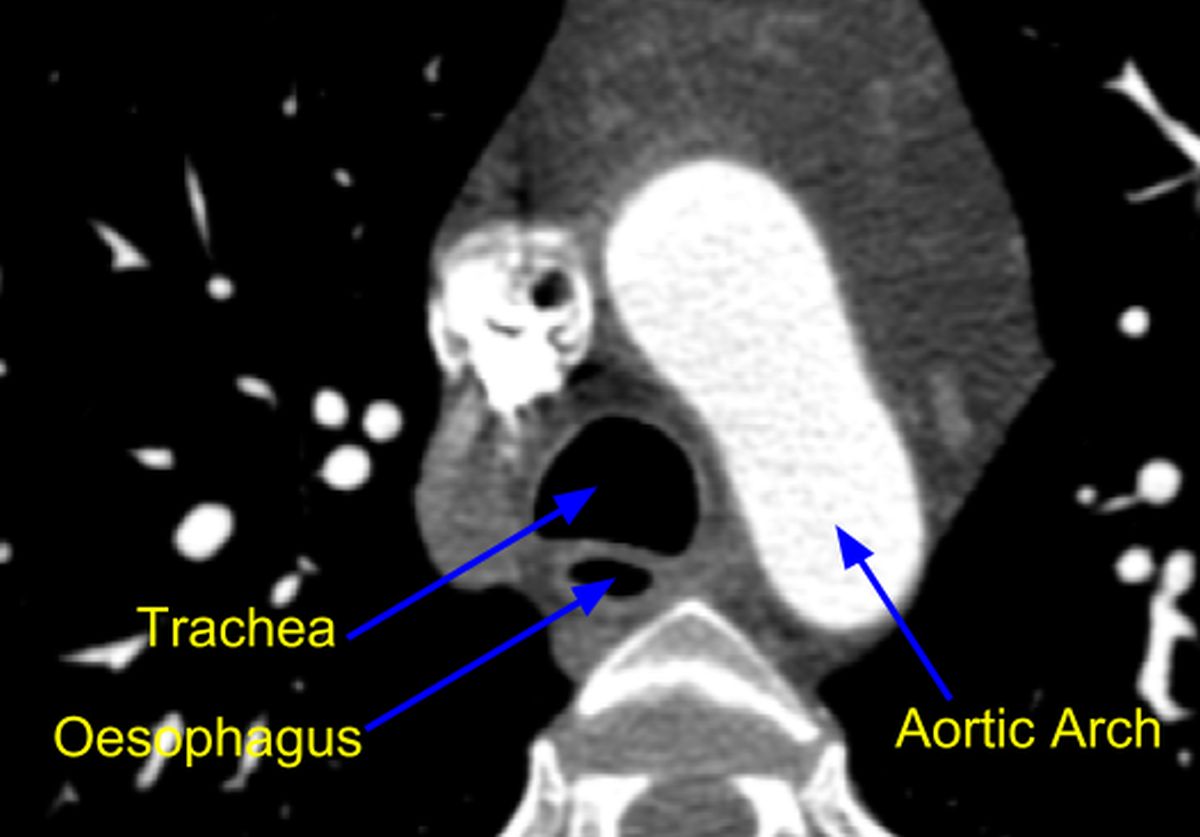 Cardiac CT scan - Aortic arch level