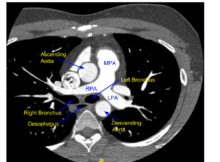 Cardiac CT scan Archives - All About Cardiovascular System and Disorders