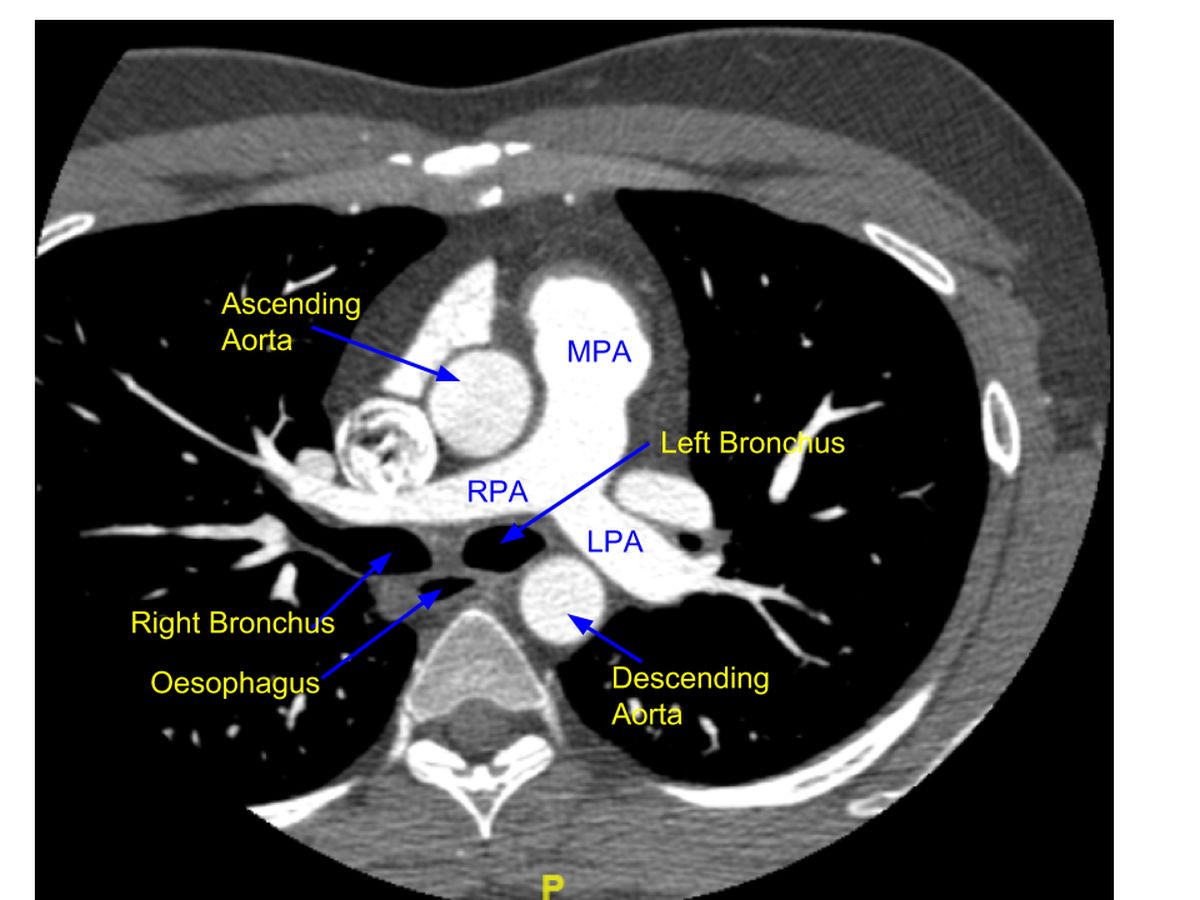 Cardiac CT pulmonary artery bifurcation
