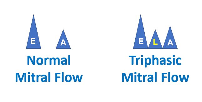 Triphasic mitral flow