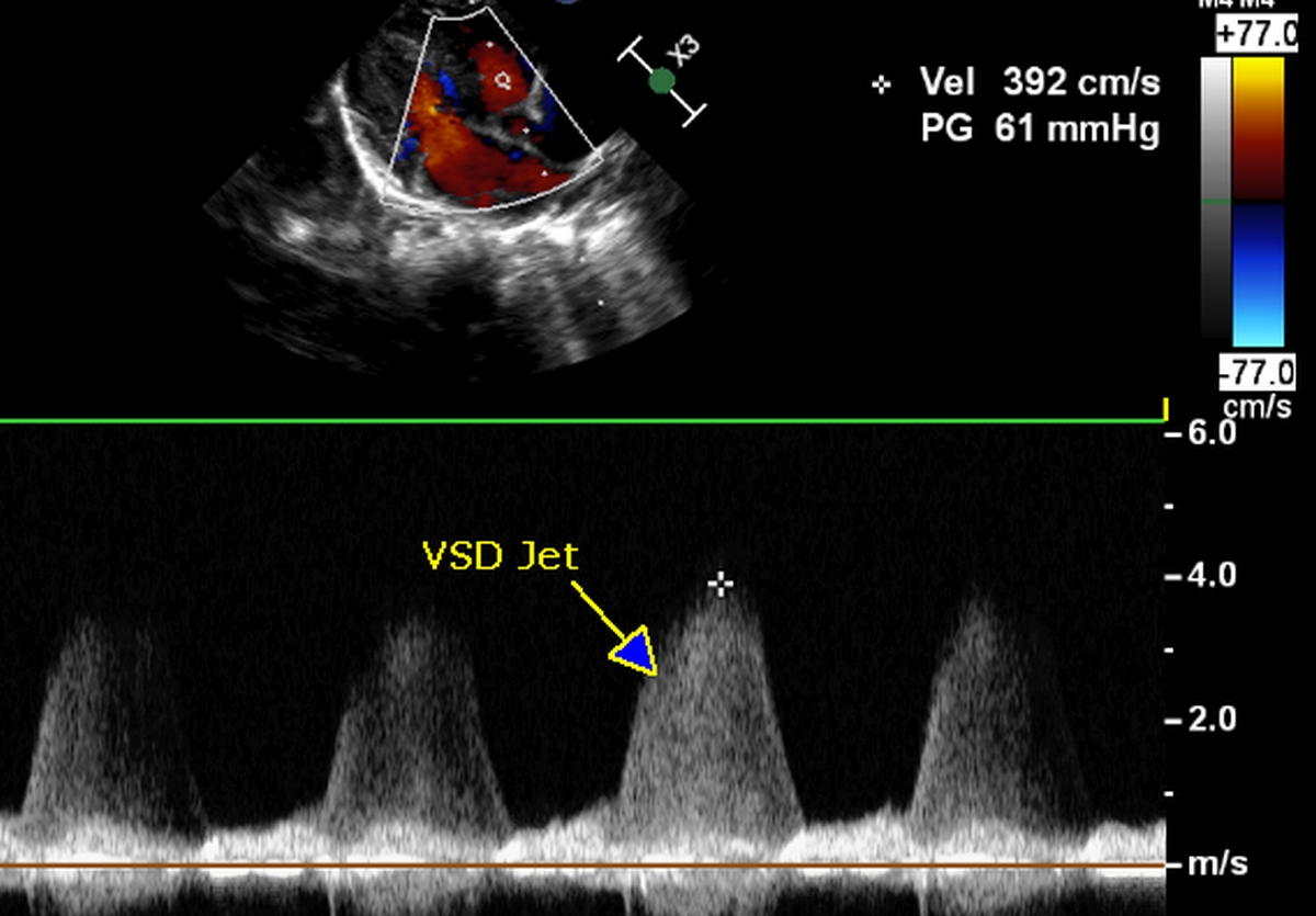 Echocardiogram in ventricular septal defect