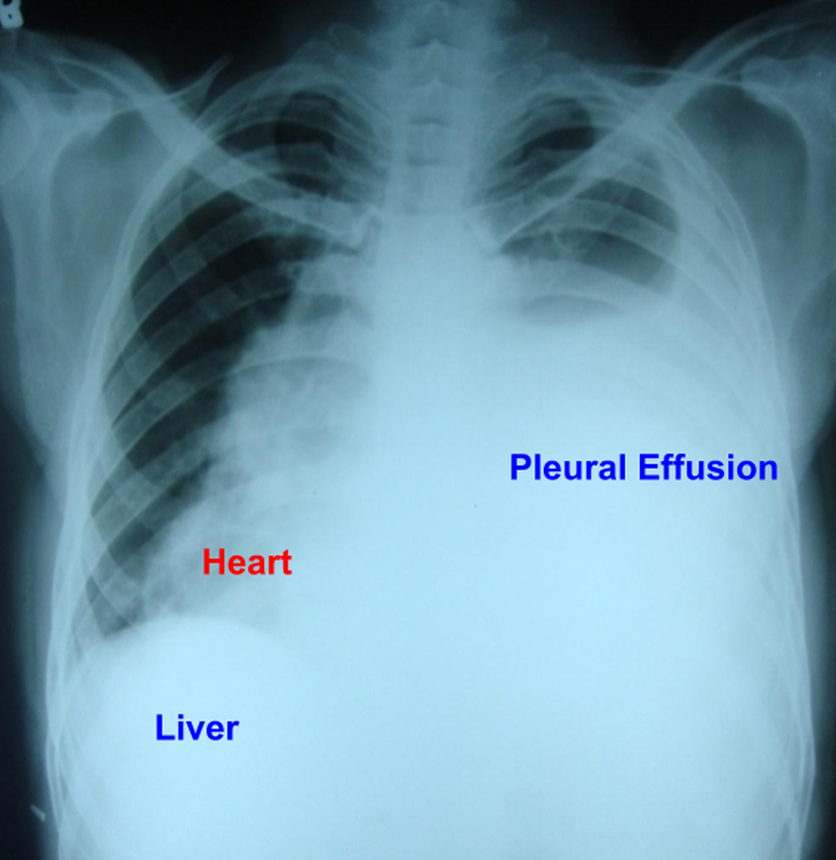 Left sided pleural effusion with dextroposition