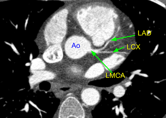 Cardiac CT - Left coronary artery