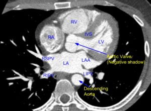 Cardiac Ct - Pulmonary Veins And Left Atrium