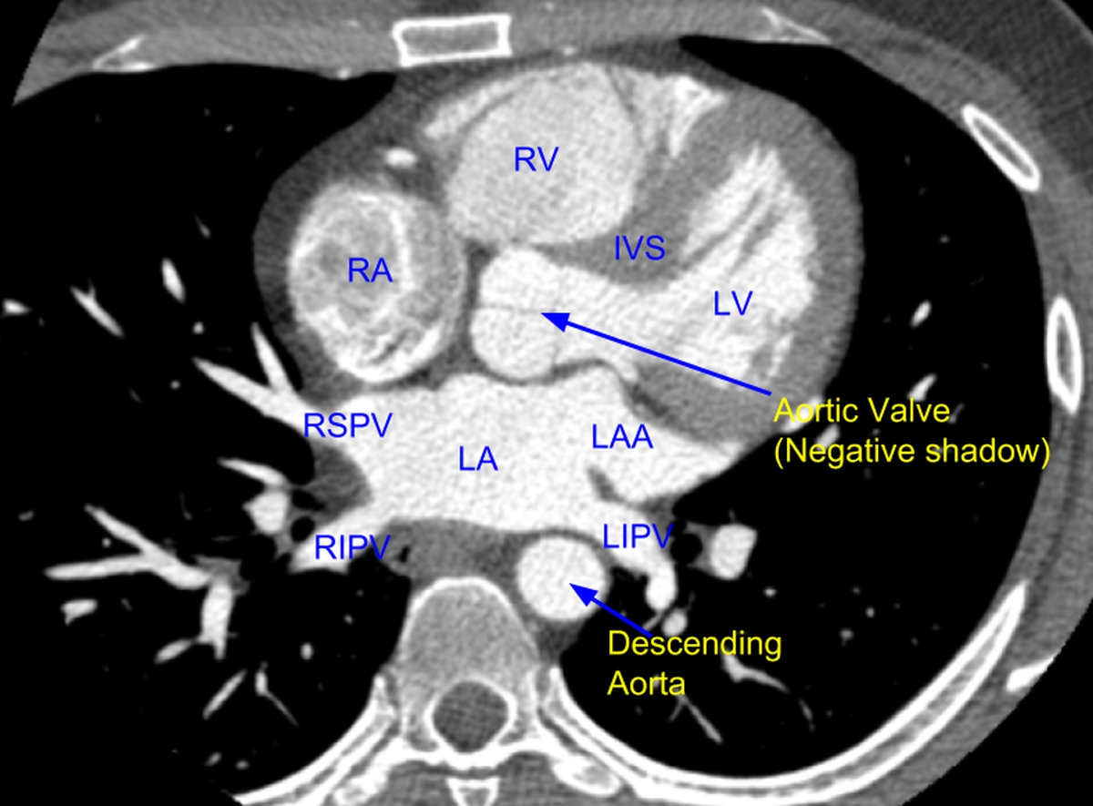 Cardiac CT scan showing pulmonary veins and left atrium