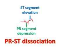 PR-ST dissociation