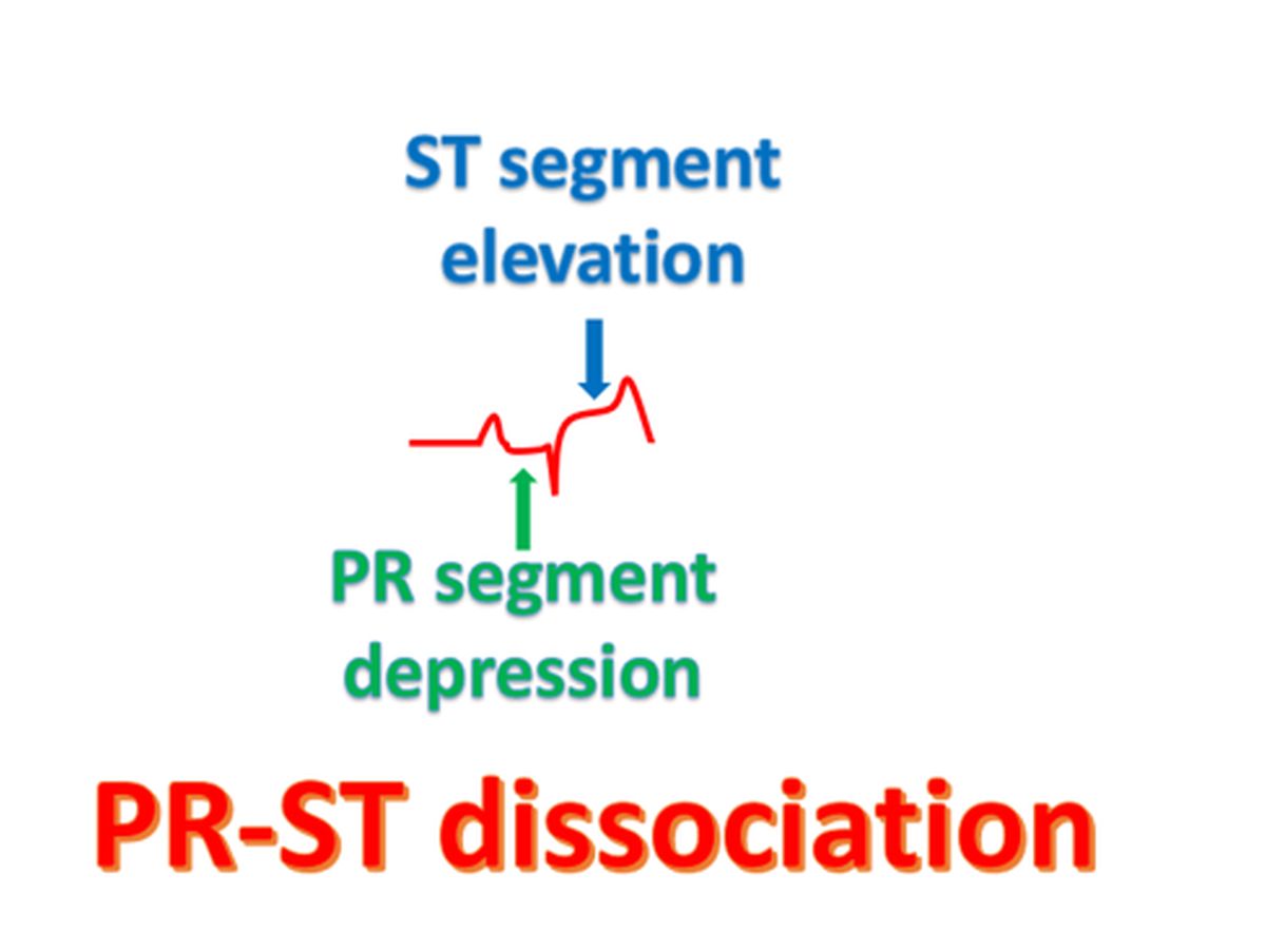 PR-ST dissociation