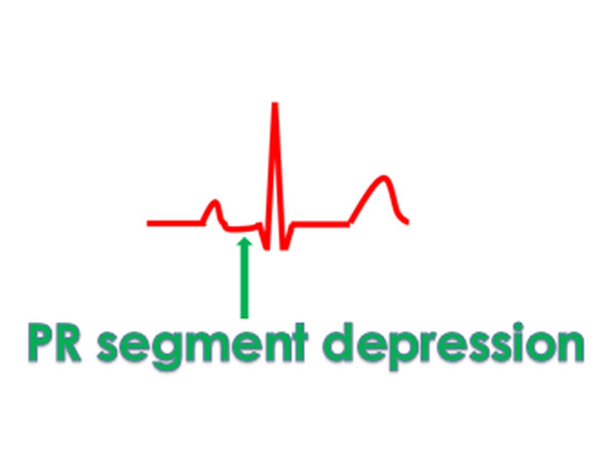 PR segment depression