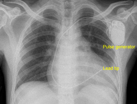 Septal pacing - X-ray chest PA view