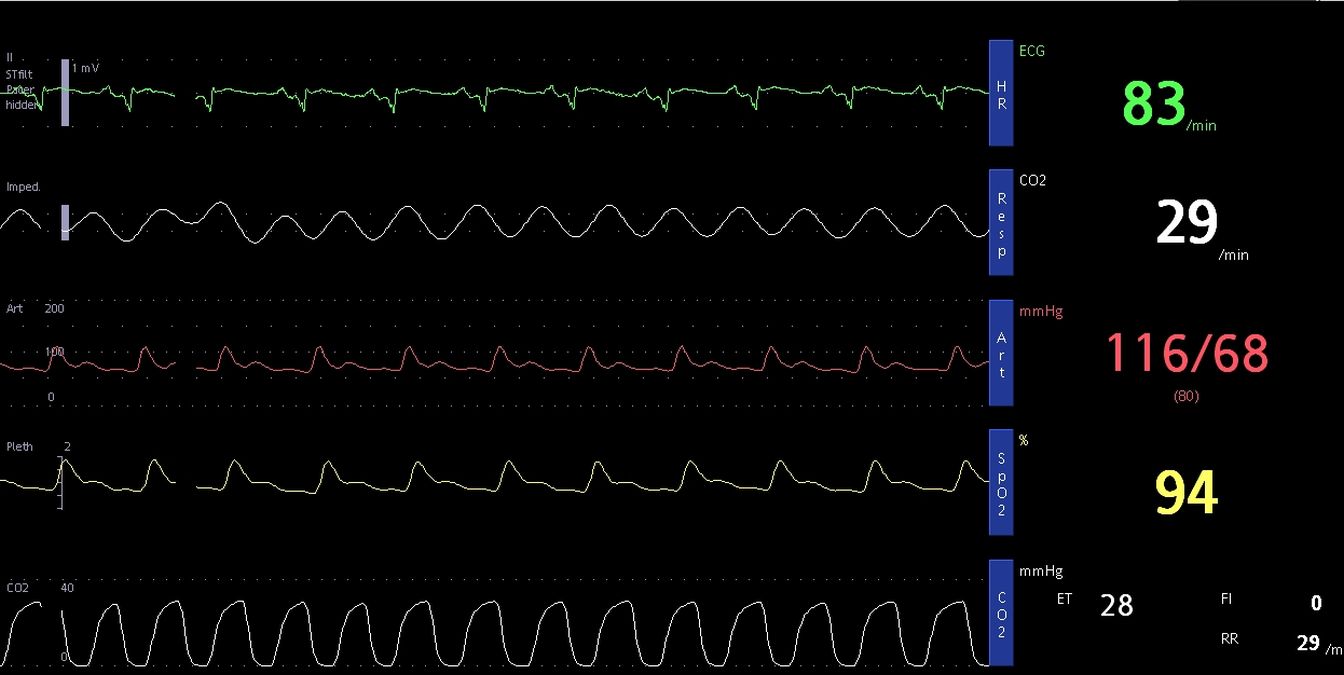 Etco2 Monitoring In Icu - End Tidal Carbon Dioxide (capnography)