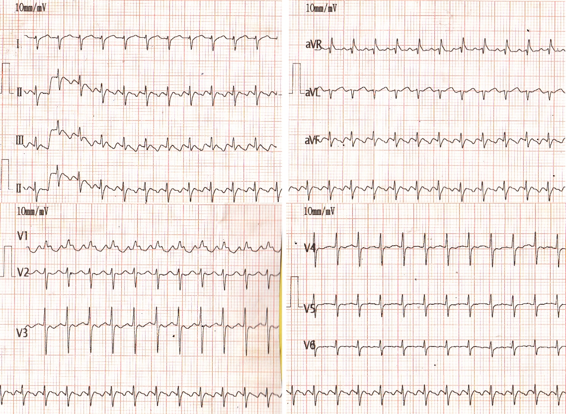 Neonatal atrial flutter