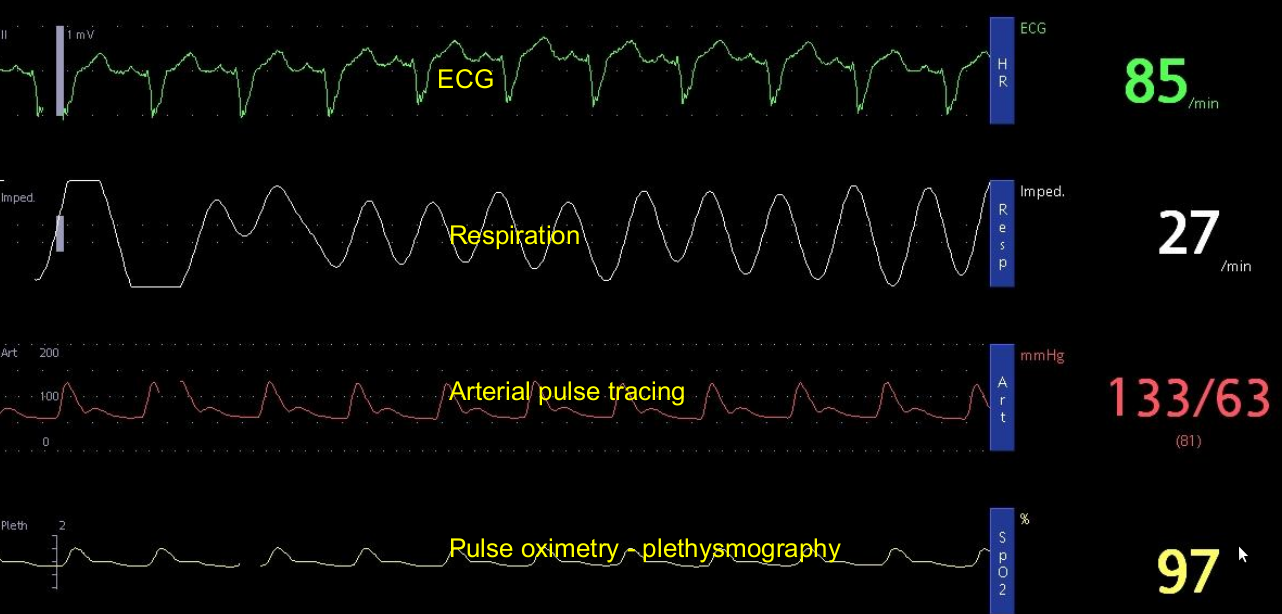 Arterial tracing in sinus rhythm