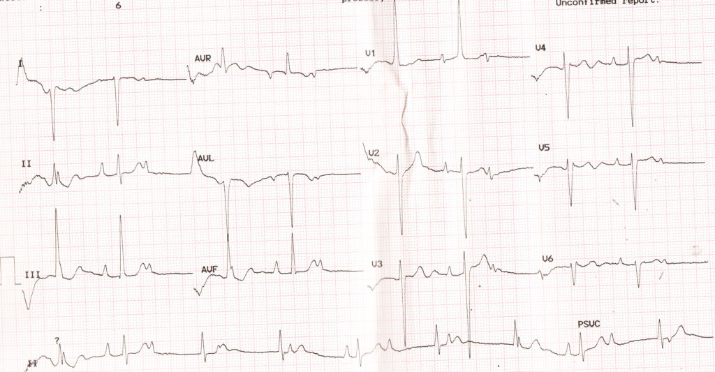 Complete heart block and right ventricular hypertrophy