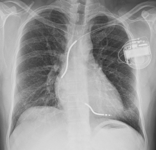 Chest X-ray showing implantable cardioverter defibrillator