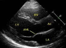 Parasternal long axis (PLAX) view in echocardiogram – animated view ...