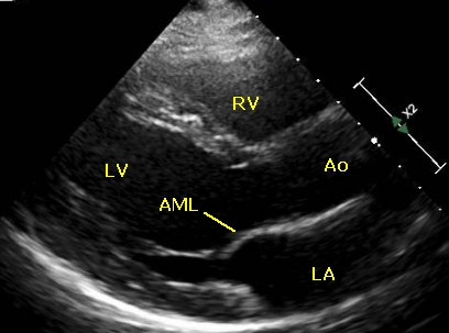 Annotated PLAX view