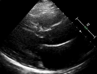 Mitral valve partially open