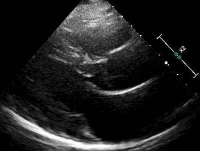 Mitral valve wide open