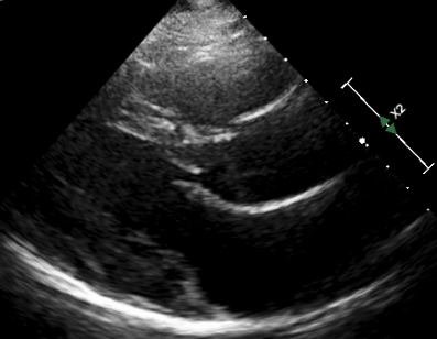 Open mitral valve