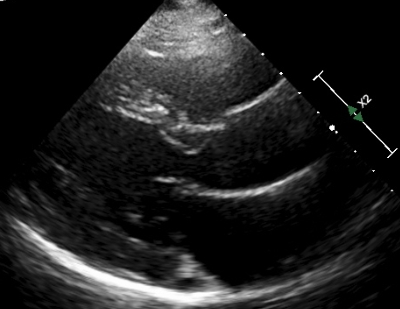 Mitral vale closing