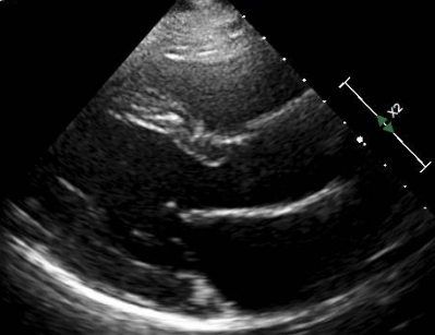 Mitral valve continuing to close