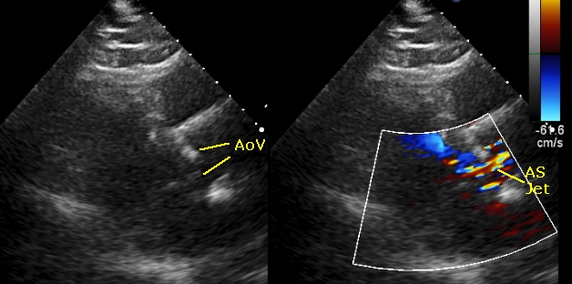 Aortic stenosis colour jet