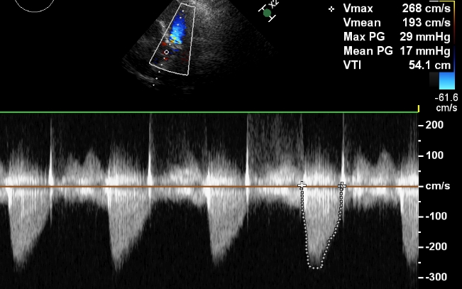 Aortic stenosis jet on continuous wave (CW) Doppler